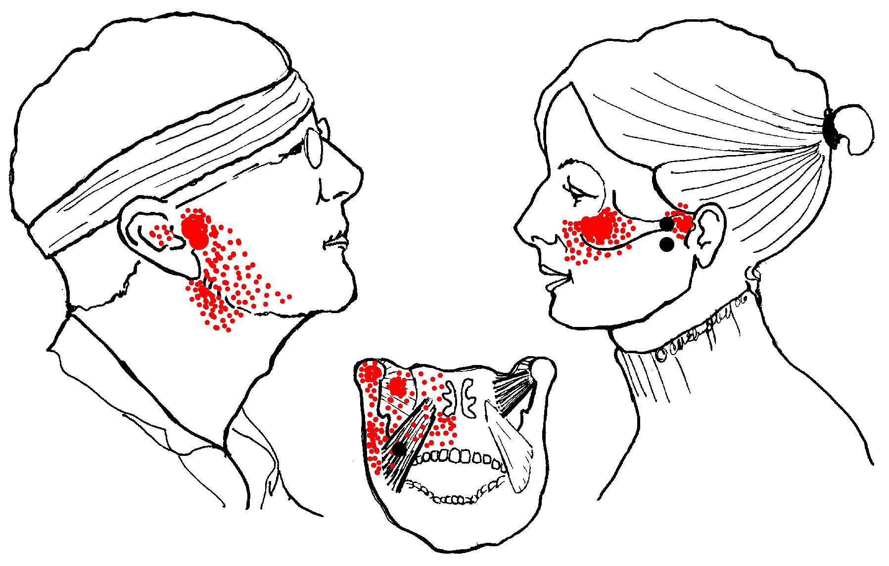 Pterygoid-pain